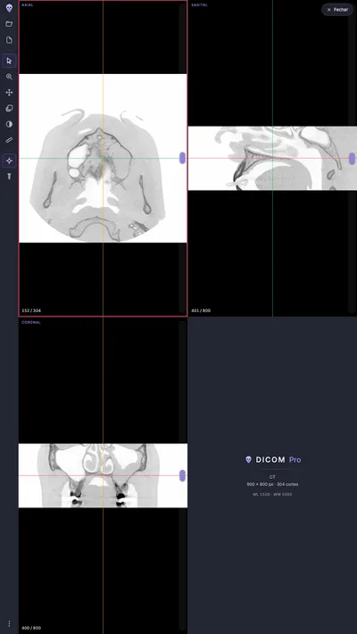 As três janelas de reconstrução com o filtro de raio-X invertido aplicado: a escala de cinza aparece invertida, com a imagem clara sobre o fundo escuro da interface.